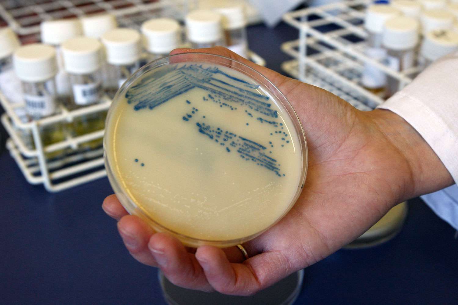 What you need to know: The Antibiotic-Resistant Superbugs