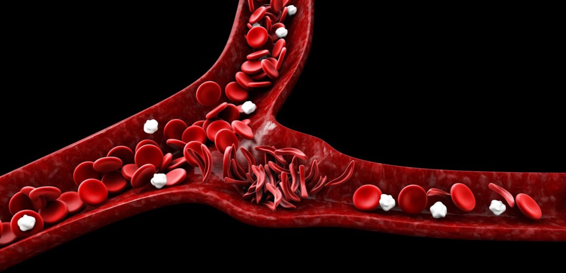 The Rapidly Rising Sickle Cell Disease In The UK: What You Need To Know?