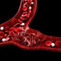The Rapidly Rising Sickle Cell Disease In The UK: What You Need To Know?