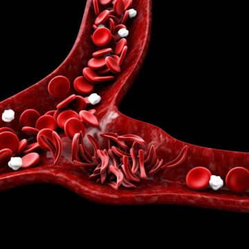 The Rapidly Rising Sickle Cell Disease In The UK: What You Need To Know?