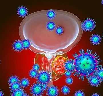 prostrate cancer